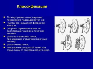 КлассификацияКлассификация
 По виду травмы почки закрытыеПо виду травмы почки закрытые
повреждения подразделяются на:повреждения подразделяются на:
 ушибы без нарушения фибрознойушибы без нарушения фиброзной
капсулы;капсулы;
 разрывы паренхимы почки, неразрывы паренхимы почки, не
достигающие чашечек и почечнойдостигающие чашечек и почечной
лоханки;лоханки;
 разрывы паренхимы почки,разрывы паренхимы почки,
проникающие в чашечки и почечнуюпроникающие в чашечки и почечную
лоханку;лоханку;
 размозжение почки;размозжение почки;
 повреждение сосудистой ножки илиповреждение сосудистой ножки или
отрыв почки от сосудов и мочеточника.отрыв почки от сосудов и мочеточника.
 