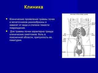 КлиникаКлиника
 Клинические проявления травмы почекКлинические проявления травмы почек
и мочеточников разнообразны ии мочеточников разнообразны и
зависят от вида и степени тяжестизависят от вида и степени тяжести
повреждения.повреждения.
 Для травмы почки характерна триадаДля травмы почки характерна триада
клинических симптомов: боль вклинических симптомов: боль в
поясничной области, припухлость ее,поясничной области, припухлость ее,
гематурия.гематурия.
 