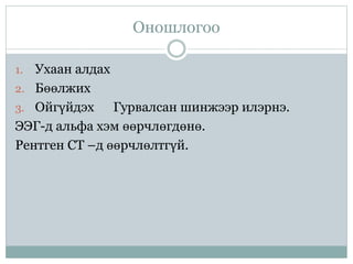 Оношлогоо
1. Ухаан алдах
2. Бөөлжих
3. Ойгүйдэх Гурвалсан шинжээр илэрнэ.
ЭЭГ-д альфа хэм өөрчлөгдөнө.
Рентген CT –д өөрчлөлтгүй.
 