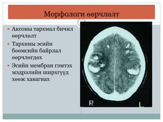 Морфологи өөрчлөлт
 Аксоны тархмал бичил
өөрчлөлт
 Тархины эсийн
бөөмсийн байрлал
өөрчлөгдөх
 Эсийн мембран гэмтэх
мэдрэлийн ширхгүүд
хөөж хавагнах
 