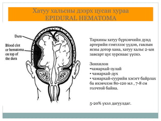 Хатуу хальсны дээрх цусан хураа
EPIDURAL HEMATOMA
Тархины хатуу бүрхэвчийн дунд
артерийн гэмтлээс үүдэн, гавлын
ясны дотор хана, хатуу хальс 2-ын
завсарт цус хурснаас үүснэ.
Зонхилон
•чамархай-зулай
• чамархай-дух
• чамархай-суурийн хэсэгт байрлах
ба ихэвчлэн 80-120 мл , 7-8 см
голчтой байна.
5-20% үхэл дагуулдаг.
 