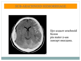 SUB-ARACHNOID HEMORRHAGE
Цус алдалт arachnoid
болон
pia mater 2-ын
завсарт явагдана.
 