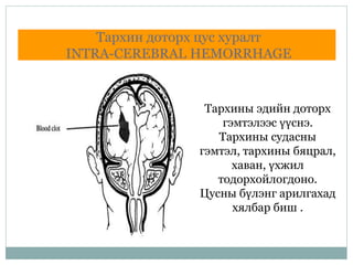 Тархин доторх цус хуралт
INTRA-CEREBRAL HEMORRHAGE
Тархины эдийн доторх
гэмтэлээс үүснэ.
Тархины судасны
гэмтэл, тархины бяцрал,
хаван, үхжил
тодорхойлогдоно.
Цусны бүлэнг арилгахад
хялбар биш .
 