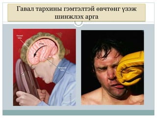 Гавал тархины гэмтэлтэй өвчтөнг үзэж
шинжлэх арга
 