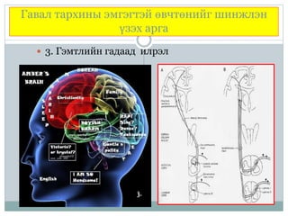 Гавал тархины эмгэгтэй өвчтөнийг шинжлэн
үзэх арга
 3. Гэмтлийн гадаад илрэл
 