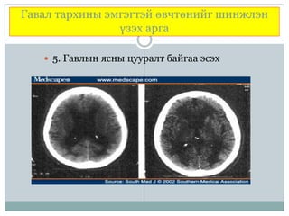 Гавал тархины эмгэгтэй өвчтөнийг шинжлэн
үзэх арга
 5. Гавлын ясны цууралт байгаа эсэх
 