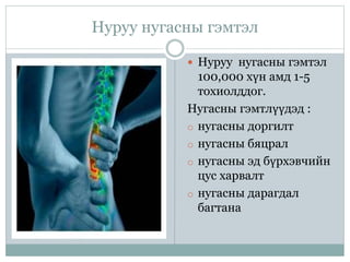 Нуруу нугасны гэмтэл
 Нуруу нугасны гэмтэл
100,000 хүн амд 1-5
тохиолддог.
Нугасны гэмтлүүдэд :
o нугасны доргилт
o нугасны бяцрал
o нугасны эд бүрхэвчийн
цус харвалт
o нугасны дарагдал
багтана
 