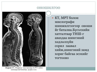 оношилгоо
 КТ, МРТ болон
миелографи
шинжилгээгээр оноши
йг батална.Бүсэлхийн
хатгалтаар ТНШ-г
авахдаа шингэний
хөдлөлзүйн
сорил заавал
хийж,шингэний замд
хориг байгаа эсэхийг
тогтооно
 