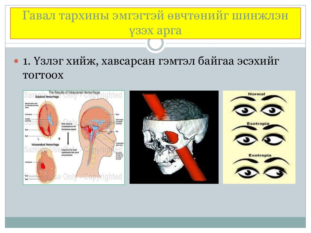 гавал тархины гэмтэл