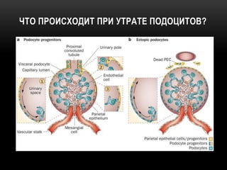 ЧТО ПРОИСХОДИТ ПРИ УТРАТЕ ПОДОЦИТОВ?
 