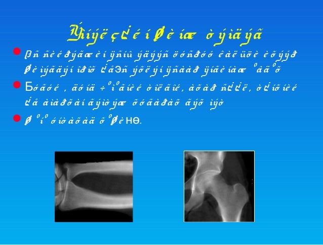Osteoporoz Osteoporoz