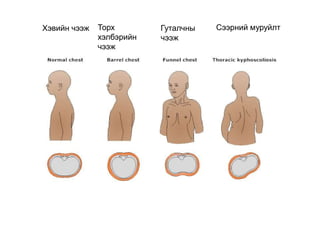 Торх
хэлбэрийн
чээж
Гуталчны
чээж
Хэвийн чээж Сээрний муруйлт
 