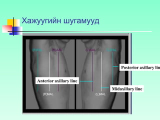 Хажуугийн шугамууд
Anterior axillary line
Midaxillary line
Posterior axillary lin
 