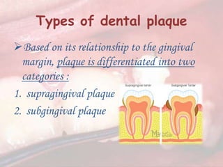 Dental plaque formation | PPT