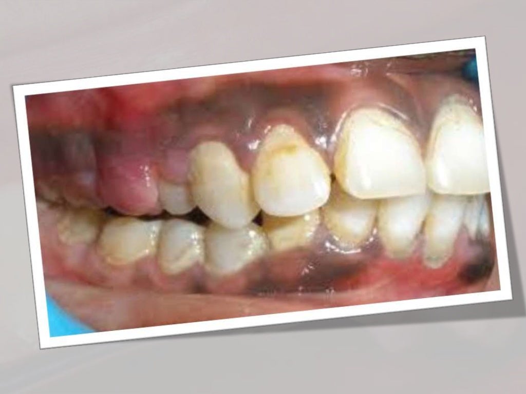 Dental plaque formation