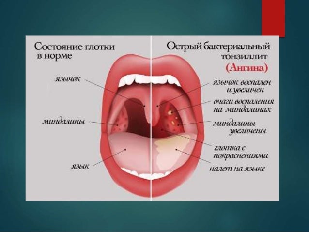 острый тонзиллит
