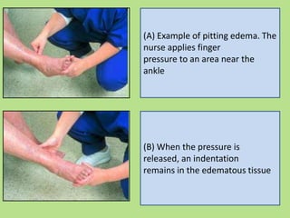 (B) When the pressure is
released, an indentation
remains in the edematous tissue
(A) Example of pitting edema. The
nurse applies finger
pressure to an area near the
ankle
 