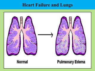 Heart Failure and Lungs
 