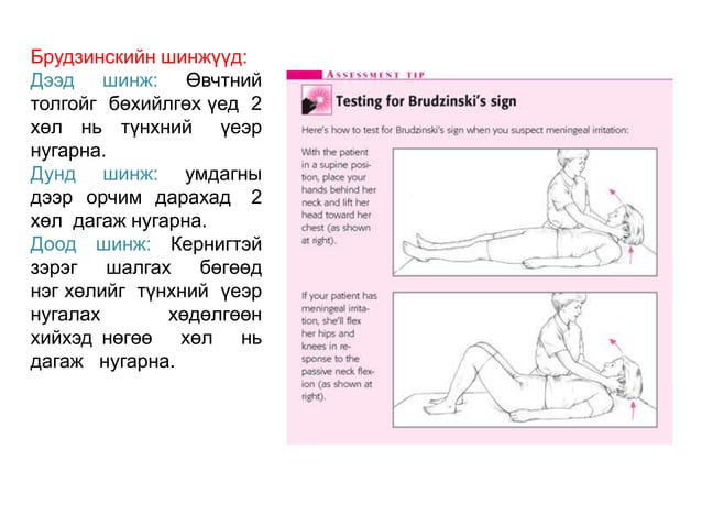 менингит - -мэдрэл судлал | PPT