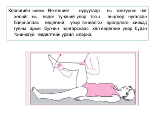 Кернигийн шинж: Өвчтөнийг нуруугаар нь хэвтүүлж нэг
хөлийг нь өвдөг түнхний үеэр тэгш өнцгөөр нугалсан
байрлалаас өвдөгний үеэр тэнийлгэх оролдлого хийхэд
гуяны арын булчин чангарснаас хөл өвдөгний үеэр бүрэн
тэнийхгүй өвдөлтийн урвал илэрнэ.
 