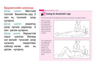 Брудзинскийн шинжүүд:
Дээд шинж: Өвчтний
толгойг бөхийлгөх үед 2
хөл нь түнхний үеэр
нугарна.
Дунд шинж: умдагны
дээр орчим дарахад 2
хөл дагаж нугарна.
Доод шинж: Кернигтэй
зэрэг шалгах бөгөөд
нэг хөлийг түнхний үеэр
нугалах хөдөлгөөн
хийхэд нөгөө хөл нь
дагаж нугарна.
 