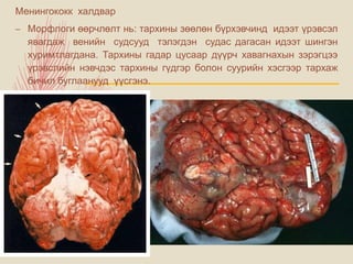Менингококк халдвар
– Морфлоги өөрчлөлт нь: тархины зөөлөн бүрхэвчинд идээт үрэвсэл
явагдаж венийн судсууд тэлэгдэн судас дагасан идээт шингэн
хуримтлагдана. Тархины гадар цусаар дүүрч хавагнахын зэрэгцээ
үрэвслийн нэвчдэс тархины гүдгэр болон суурийн хэсгээр тархаж
бичил буглаанууд үүсгэнэ.
 