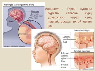 Менингит - Тархи, нугасны
бүрхэвч хальсны хурц
үрэвсэлээр илрэх хүнд
явцтай, эрсдэл ихтэй өвчин
юм
 