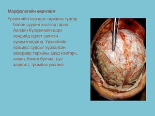 Морфологийн өөрчлөлт
Үрэвслийн нэвчдэс тархины гүдгэр
болон суурин хэсгээр гарна.
Аалзан бүрхэвчийн дорх
хөндийд идээт шингэн
хуримтлагдана. Үрэвслийн
процесс судсыг хүрээлсэн
завсраар тархины эдэд нэвтэрч,
хаван, бичил буглаа, цус
харвалт, тромбоз үүсгэнэ.
 