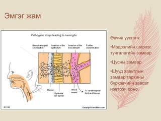 Эмгэг жам
Өвчин үүсгэгч:
•Мэдрэлийн ширхэг,
тунгалагийн замаар
•Цусны замаар
•Шууд хавьтлын
замаар тархины
бүрхэвчийн завсат
нэвтрэн орно.
 