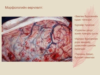 Морфологийн өөрчлөлт:
•Зөөлөн бүрхэвчийн
судас тэлэгдэх
•Цусаар түрэгдэх
•Судасны дагуу
эсийн нэвчдэс үүсэх
•Аалзан бүрхэвчийн
дорх хөндийд
үрэвслийн шингэн
хуралдах
•Тархины бодис,
бүрхэвч хавагнах
 