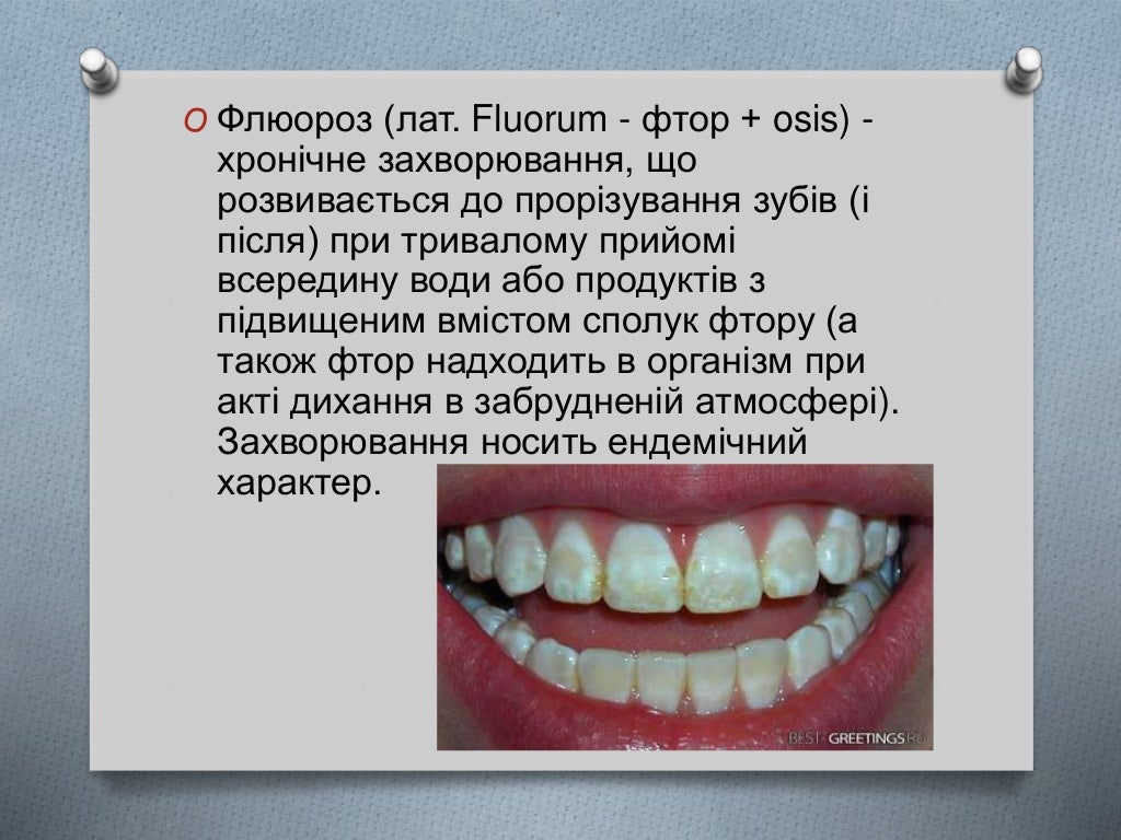 Этиология флюороза. Флюороз механизм развития. Флюороз этиология патогенез. Флюороз эмали классификация. Этиология флюороза.