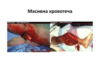 Масивна кровотеча
 