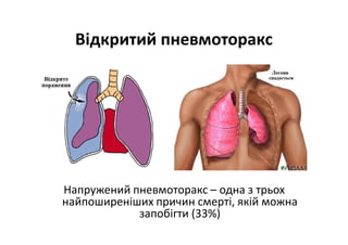 Відкритий пневмоторакс
Напружений пневмоторакс – одна з трьох
найпоширеніших причин смерті, якій можна
запобігти (33%)
 