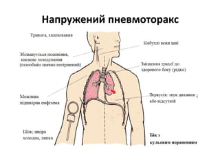 Напружений пневмоторакс
 