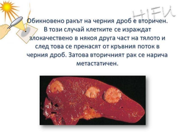 рак на черен дроб