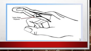 гар, сарвууны гэмтэл | PPT