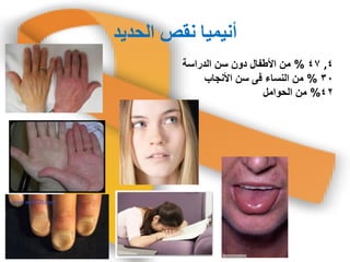 ‫انحذَذ‬ ‫وقص‬ ‫أوُمُا‬
4,47%‫الدراسة‬ ‫سن‬ ‫دون‬ ‫األطفال‬ ‫من‬
30%‫األنجاب‬ ‫سن‬ ‫فى‬ ‫النساء‬ ‫من‬
42%‫الحوامل‬ ‫من‬
 