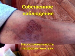 Собственное
наблюдение
Несостоятельность
перфорантных вен
 