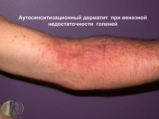 Аутосенситизационный дерматит при венозной
недостаточности голеней
 