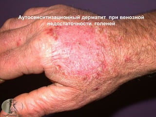 Аутосенситизационный дерматит при венозной
недостаточности голеней
 