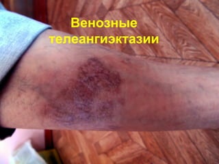 Венозные
телеангиэктазии
 
