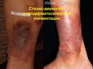 Стазис-дерматит,
липодерматосклероз и
пигментация
 