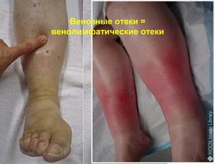 Венозные отеки =
венолимфатические отеки
 