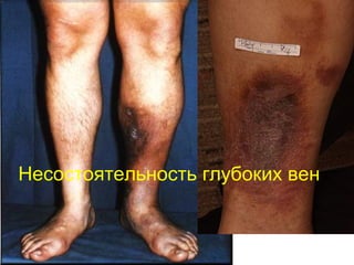 Несостоятельность глубоких вен
 