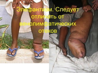 Элефантизм. Следует
отличать от
венолимфатических
отеков
 