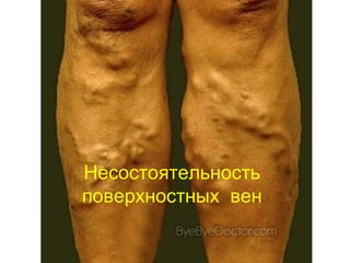 Несостоятельность
поверхностных вен
 