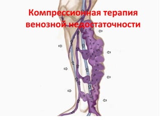 Компрессионная терапия
венозной недостаточности
 