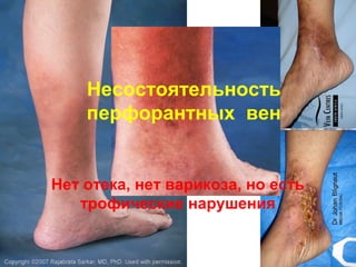 Несостоятельность
перфорантных вен
Нет отека, нет варикоза, но есть
трофические нарушения
 