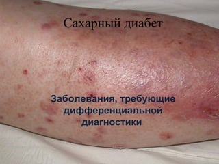 Сахарный диабет
Заболевания, требующие
дифференциальной
диагностики
 