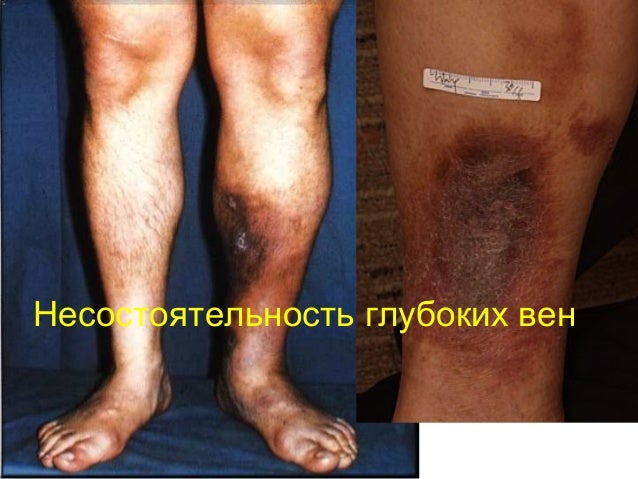 Флебодиа отзывы при варикозе ног